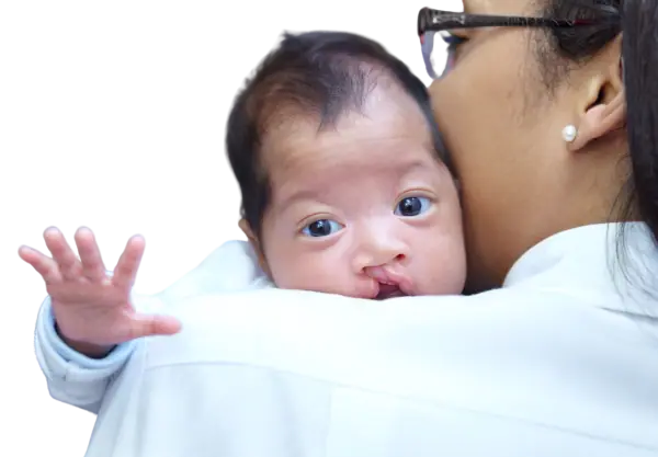 Cleft child with mother no background